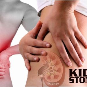 kidney stone treatment