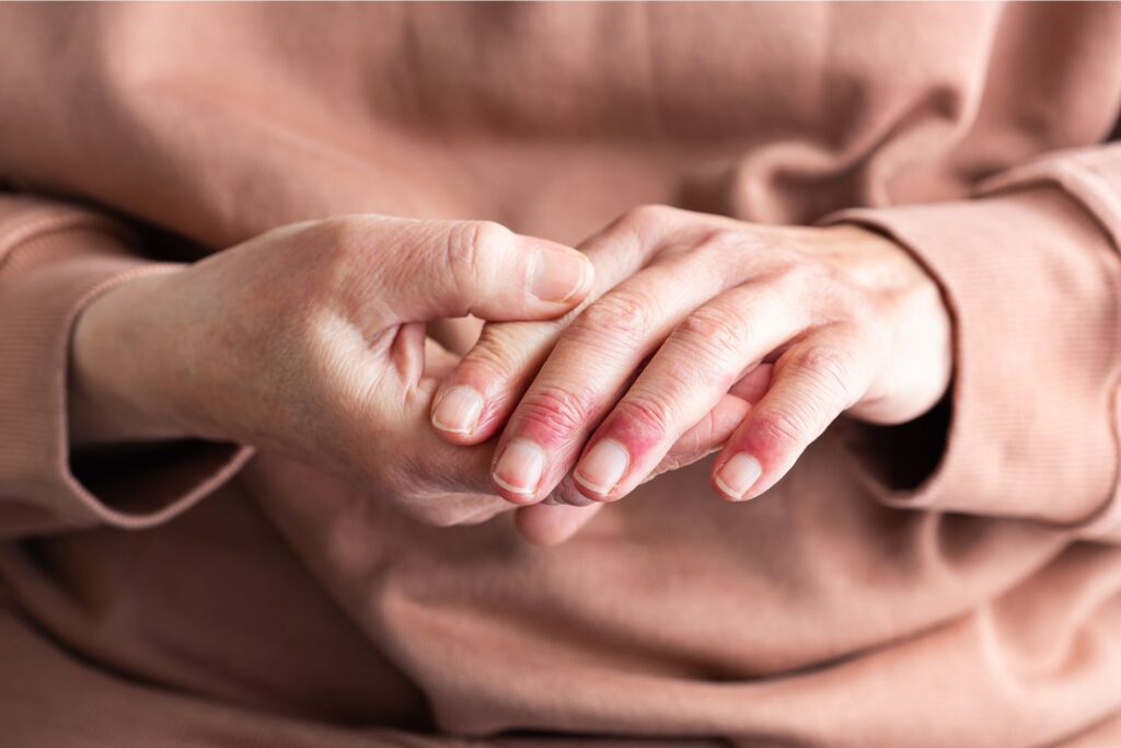 Skin Allergies and Eczema