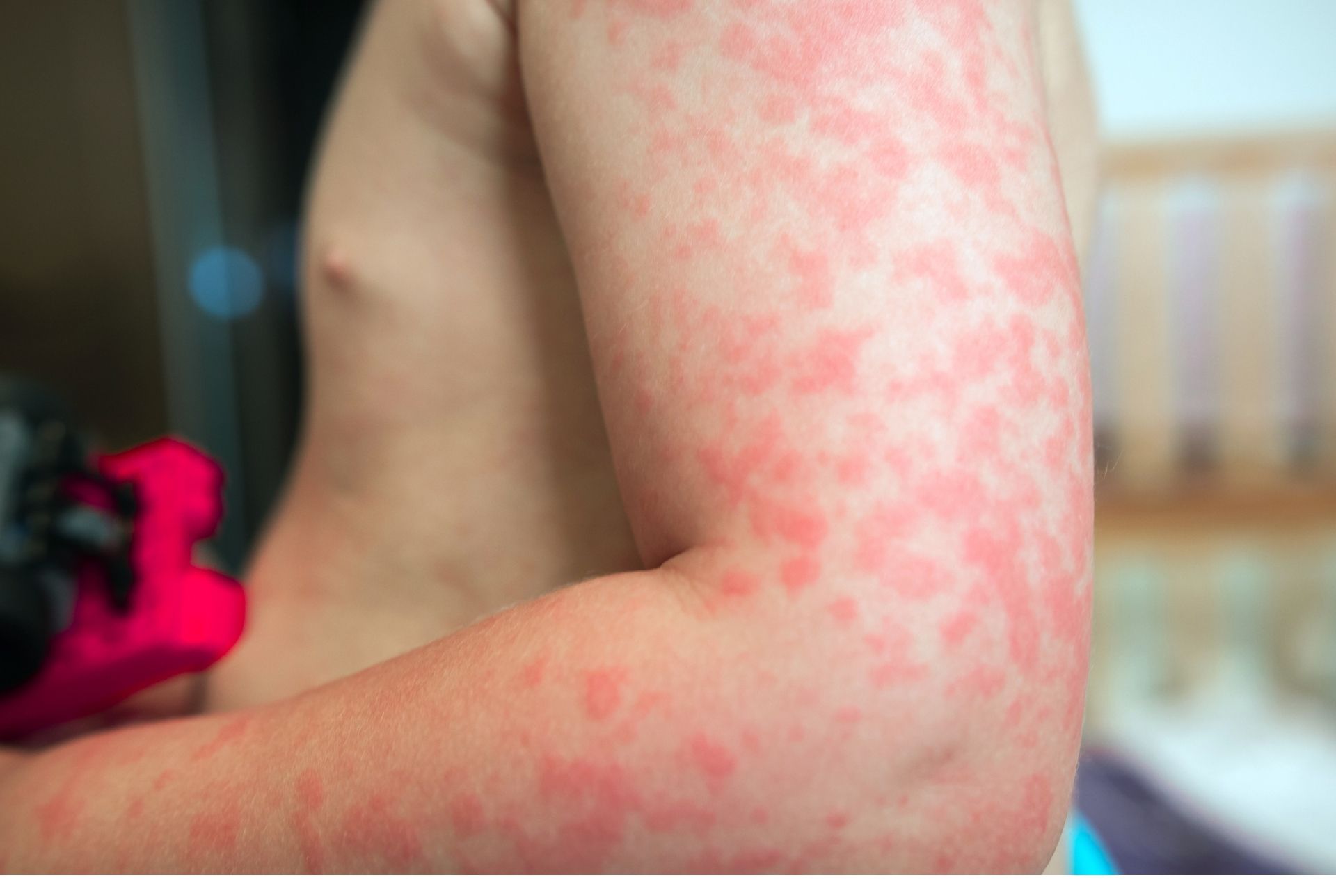 Homeo treatment for Dust Allergy, Skin Allergy & Food Allergy