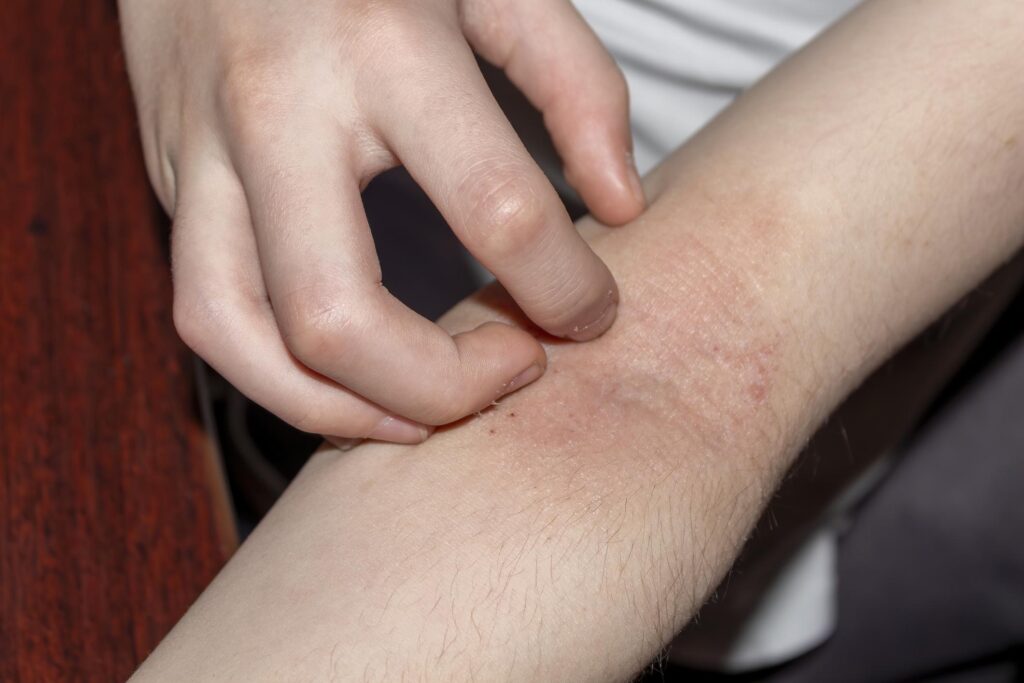 Skin Problems During Summer