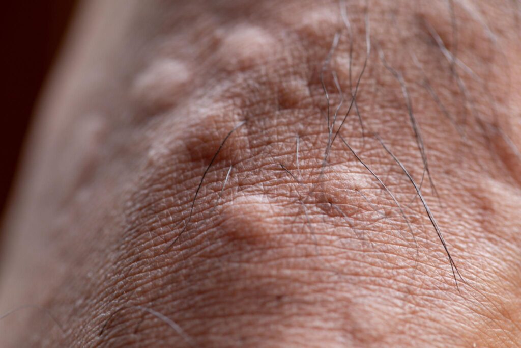 Ant Bites – Small but Irritating homeotreatment