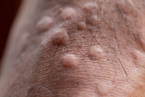 Ant Bites – Small but Irritating homeotreatment